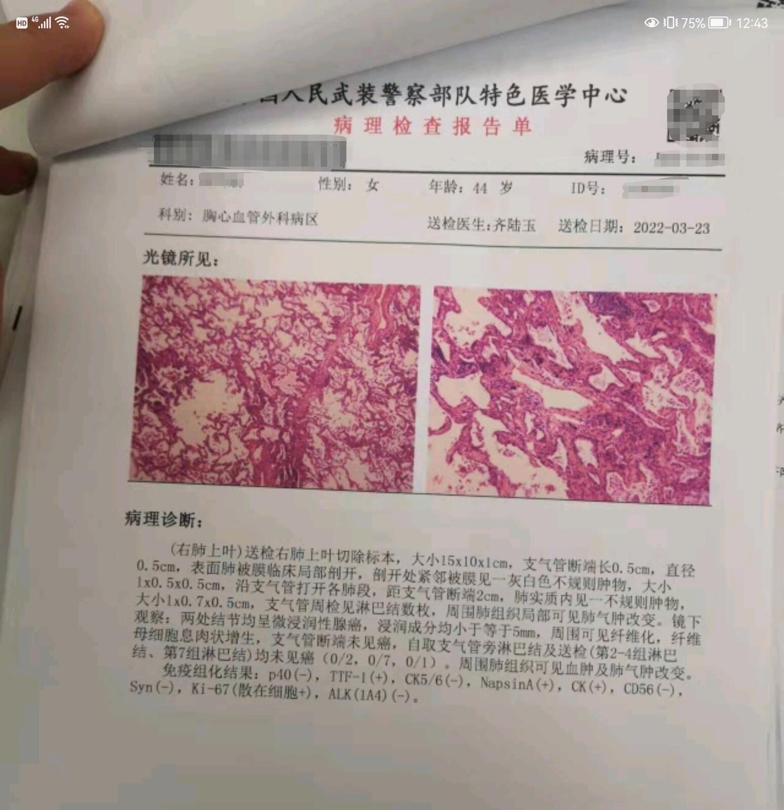 肺腺癌手术后寿命影响因素概览