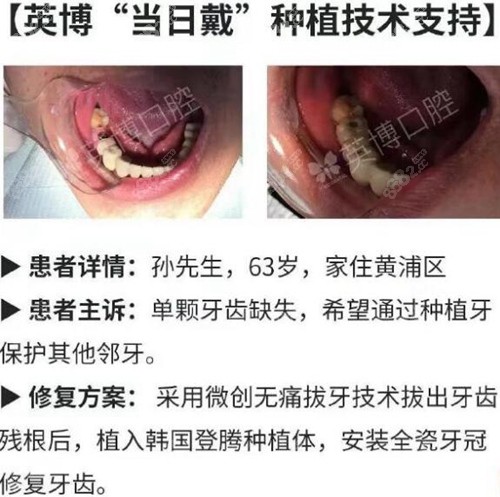 种植牙十大品牌引领口腔种植技术新时代