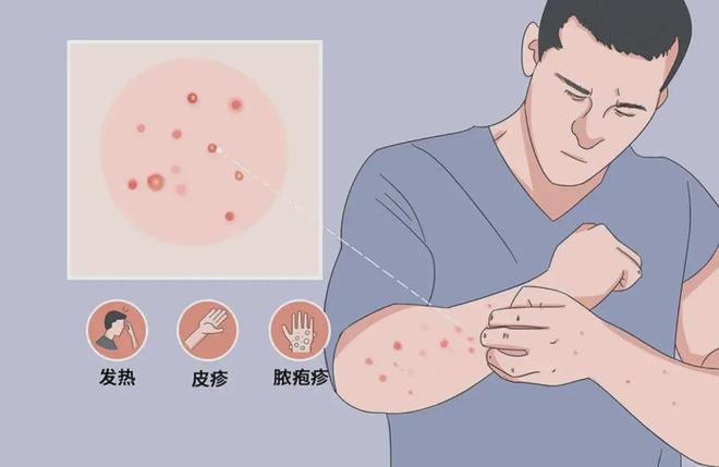 猴痘初期症状详解，预防、应对及图片指南